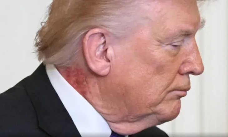 Spekulimet për shëndetin e Trump pas njollës së kuqe në qafën e tij, reagon mjeku personal i presidentit: Mund të zgjasë disa javë, po e trajton me një krem që…