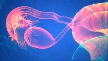 Cili është emri i ri për PCOS? Ja çfarë duhet të dinë pacientët