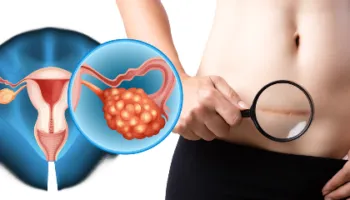 Kanceri i mitrës/ Vaksina HPV, arritje historike në Australi