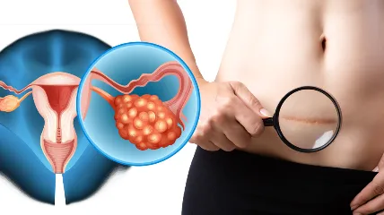 Kanceri i mitrës/ Vaksina HPV, arritje historike në Australi