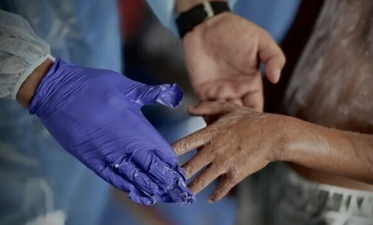 OKB raporton 125 mijë raste të infeksioneve të lëkurës në Gaza të lidhura me minjtë dhe parazitët