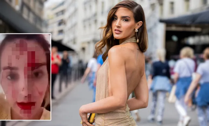 Skandal në Kanë/ Miss Venezuela publikon videon tronditëse me fytyrën e mbuluar në gjak, akuzon stilistin e njohur për dhunë