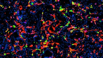 Nanopjesëzat, efektive kundër kancerit të prostatës