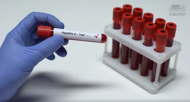 Dita Botërore e Hepatiteve, MSH: Miratohet për herë të parë Plani Kombëtar për Eliminimin e Hepatiteve Virale