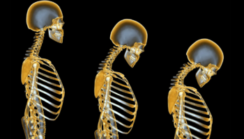 Osteoporoza nuk prek vetëm kockat…