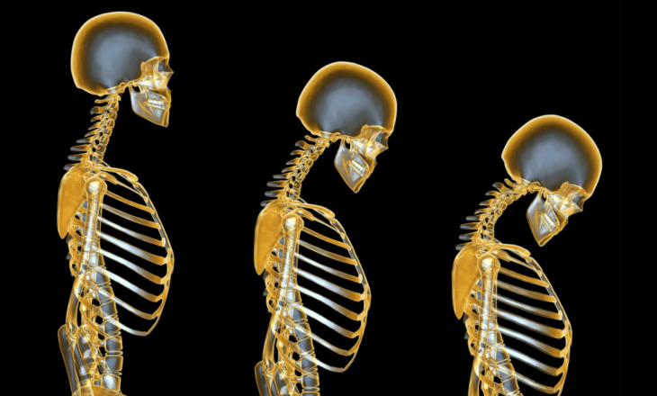 Osteoporoza nuk prek vetëm kockat…