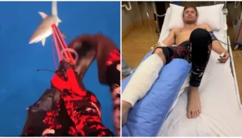 Peshkaqeni sulmon influencerin në Fixhi, i nënshtrohet katër operacioneve për të shpëtuar këmbën (VIDEO)