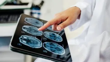 Shkencëtarët identifikojnë bakteret që nxisin sklerozën e shumëfishtë