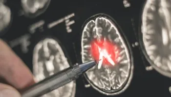 Udhëtimi që i ndryshoi jetën: U kthye nga India me 38 parazitë në tru