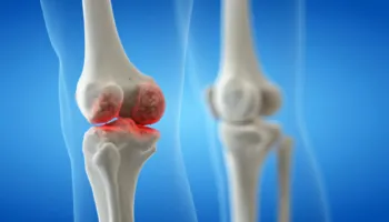 Dhimbjet e gjurit nuk janë të pashmangshme, ja 5 mënyra për të ulur rrezikun e osteoartritit