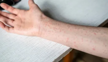 SHBA në alarm, 2 persona vdesin nga fruthi në Pensilvani, i pari në 35 vjet! Regjistrohen rreth 400 të prekur