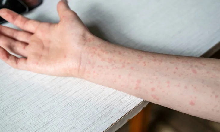 SHBA në alarm, 2 persona vdesin nga fruthi në Pensilvani, i pari në 35 vjet! Regjistrohen rreth 400 të prekur