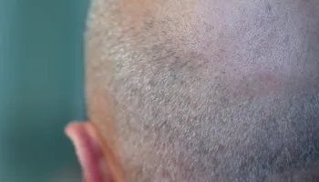Barnat për dobësim mund të rrisin rrezikun e rënies së flokëve