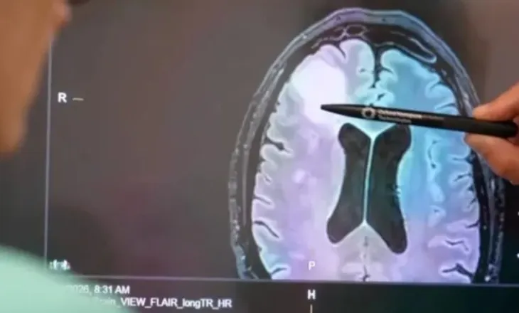 Nga javë në orë – teknologjia e re që përshpejton diagnostikimin e tumoreve të trurit