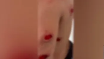 Dialogu i Rames! Pamje të rënda! I riu nga Tirana qëllohet me plumba gome në disa pjesë të trupit, plagë në gjoks, krahë dhe shpinë (VIDEO)