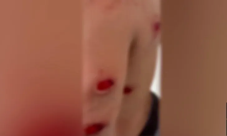 Dialogu i Rames! Pamje të rënda! I riu nga Tirana qëllohet me plumba gome në disa pjesë të trupit, plagë në gjoks, krahë dhe shpinë (VIDEO)