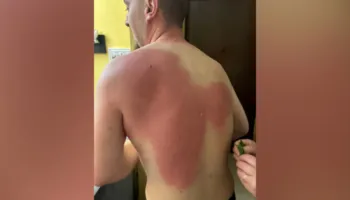 Djegie e shkallës së parë/ Gazetari Klevin Muka lëndohet gjatë protestës