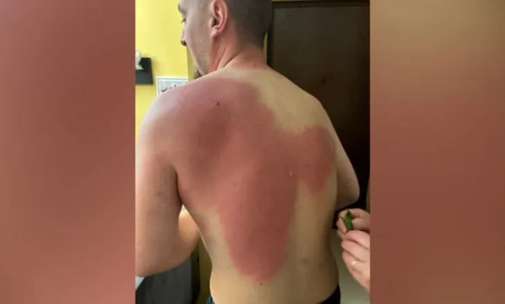 Djegie e shkallës së parë/ Gazetari Klevin Muka lëndohet gjatë protestës