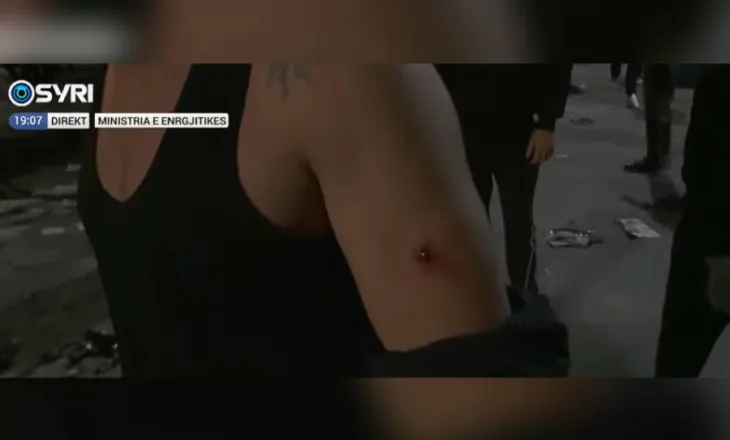 FOTOLAJM/ Policia e Ramës godet me plumb gome në krah të riun protestues