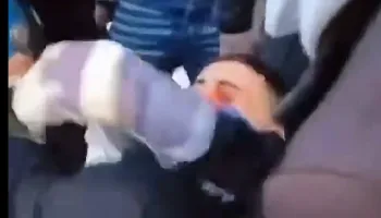 Pamje të rënda nga protesta, i riu me gjakderdhje në sy pas goditjes me plumb gome
