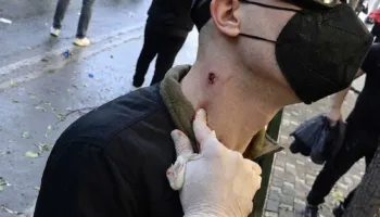 Pamjet/ Studenti tregon plagët nga plumbat e gomës në trup