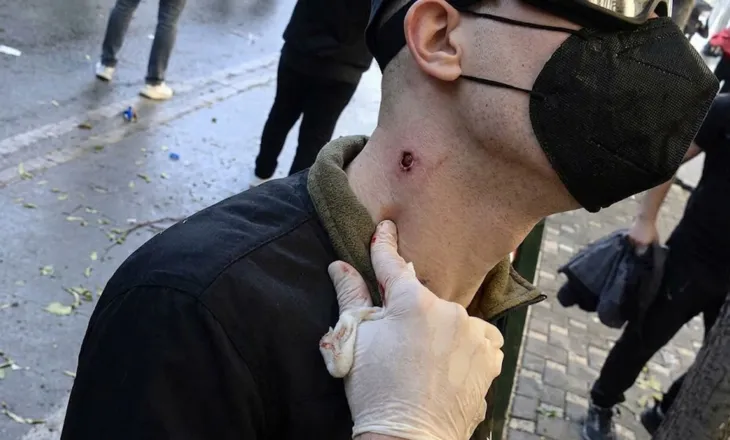 Pamjet/ Studenti tregon plagët nga plumbat e gomës në trup