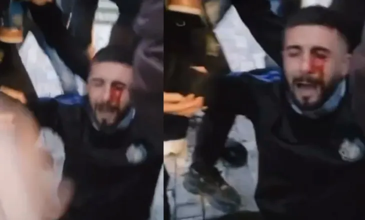 Policia e goditi me plumb gome në sy/ Erjon Vishkulli pritet të niset për në Itali për mjekim
