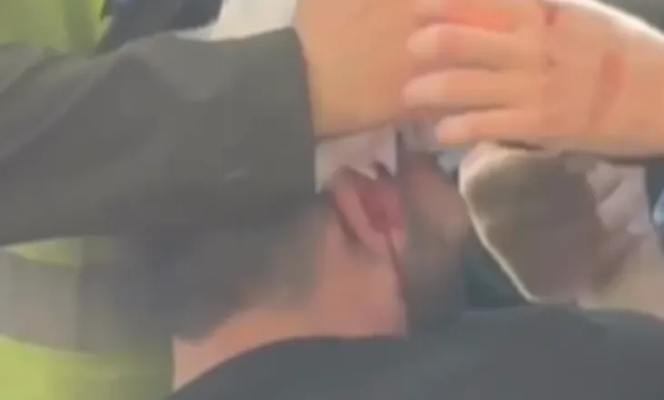 Policia shënjëstron në kokë të riun, e plagos me plumb gome, ‘vullnetarët’ ia fashojnë