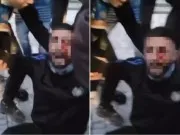 Protesta e studentëve/ Ja si paraqitet gjendja shëndetësore e të riut që u godit me plumb gome në sy