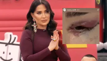Shfaqet me fytyrë të fashuar dhe sytë e nxirë/ Çfarë i ka ndodhur Rozana Radit?