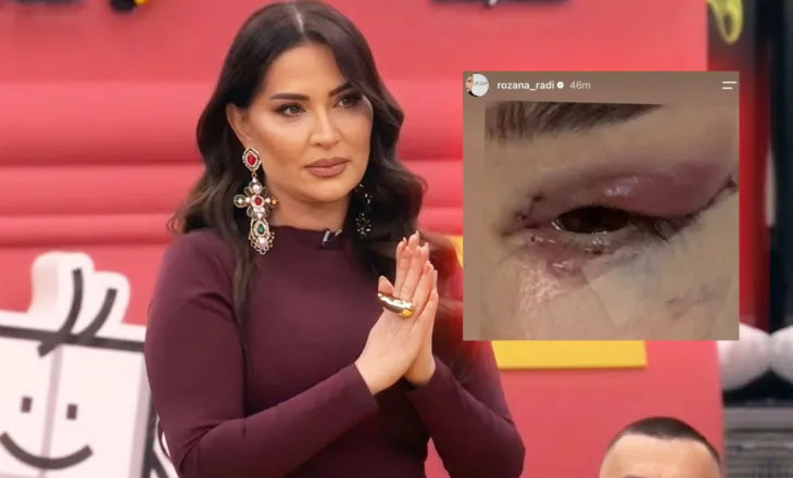 Shfaqet me fytyrë të fashuar dhe sytë e nxirë/ Çfarë i ka ndodhur Rozana Radit?