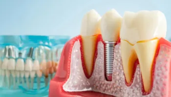 Studimi i ri zbulon rrezikun nga implantet dentare: Si mund të dëmtojnë sistemin imunitar dhe kockën e nofullës