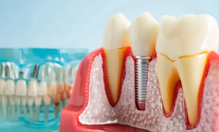 Studimi i ri zbulon rrezikun nga implantet dentare: Si mund të dëmtojnë sistemin imunitar dhe kockën e nofullës