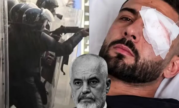 U godit nga policia me plumb gome në sy/ Demokratët Evropianë ‘shuplakë’ Ramës: Promovim politik në kurriz të Erjonit