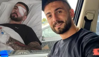 U plagos në sy gjatë protestës, Erjon Vishkulli kalon me sukses operaconin në Itali