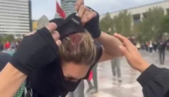Vajza e përgjakur tregon plagën e shkaktuar nga gjuajtja me gur nga policia